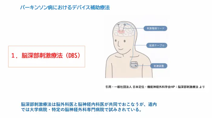 リハビリテーション勉強会資料：デバイス補助療法1 脳深部刺激療法（DBS）の図。刺激電極リードと刺激装置