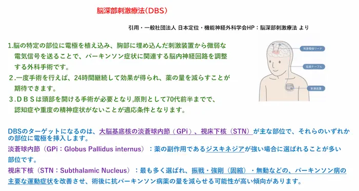 リハビリテーション勉強会資料：脳深部刺激療法（DBS）の解説。電極を植え込む淡蒼球内節（GPi）と視床下核（STN）
