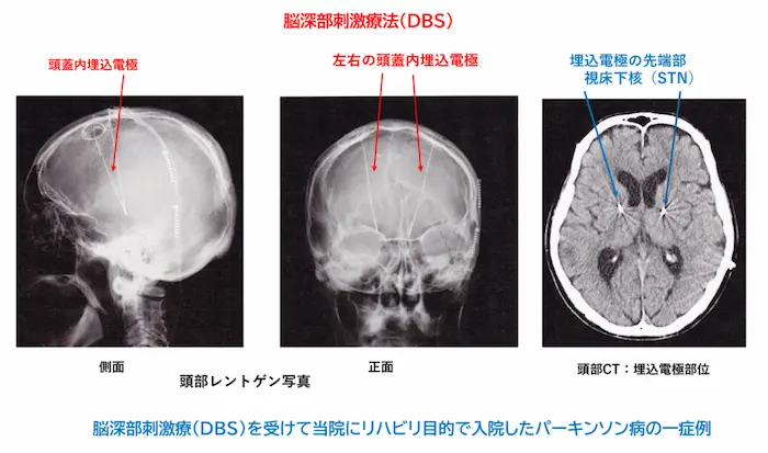 リハビリテーション勉強会資料：脳深部刺激療法（DBS）を受けてリハビリ目的で入院した症例の頭部レントゲン写真と頭部CT画像