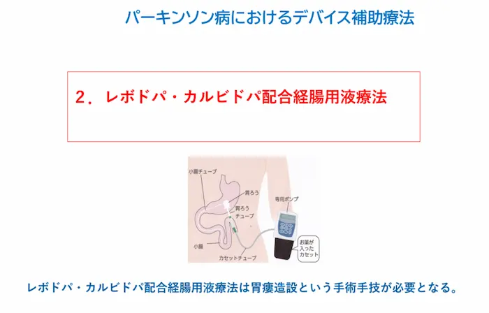リハビリテーション勉強会資料：デバイス補助療法2 レボドパ・カルビドパ配合経腸用液療法の図。胃ろうチューブと専用ポンプ