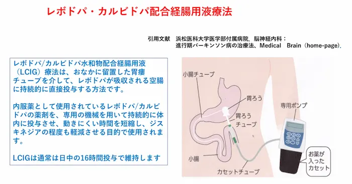 リハビリテーション勉強会資料：レボドパ・カルビドパ配合経腸用液療法（LCIG）の解説。空腸へ持続的に直接投与する方法